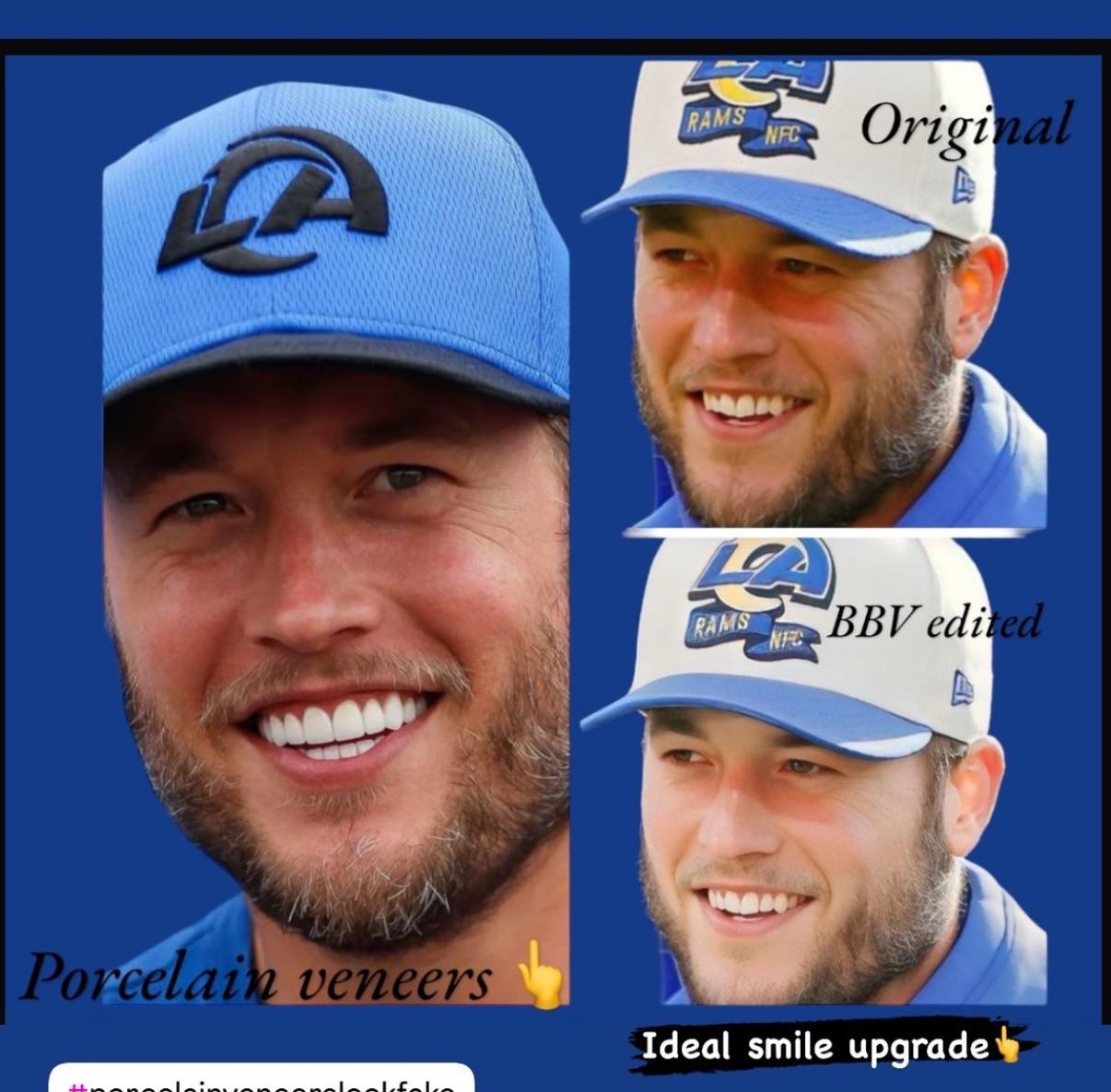 Matthew Stafford Veneers: Real or Fake? The Truth About His Teeth