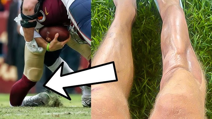 Alex Smiths leg now: Whats the latest on his condition? (Find out the amazing progress he has made)
