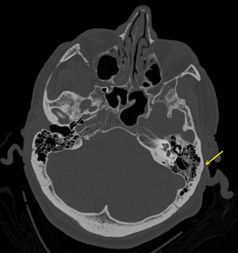 Dale Basilar Skull Fracture: Is it Fatal? Find Out Now