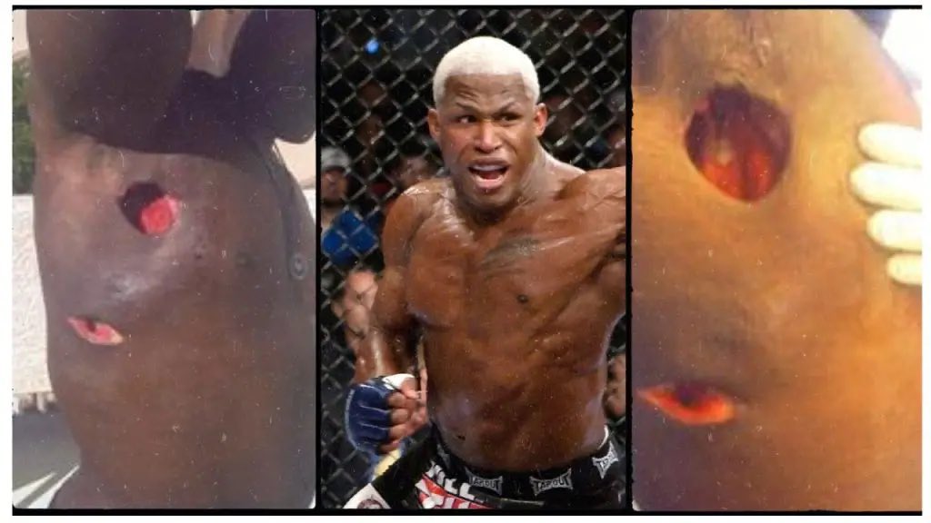 Kevin Randleman staph infectious disease causes | How do fighters get it
