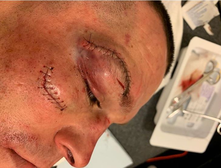 Nate Diaz Face After UFC Fight: Real Bruises and Recovery Details