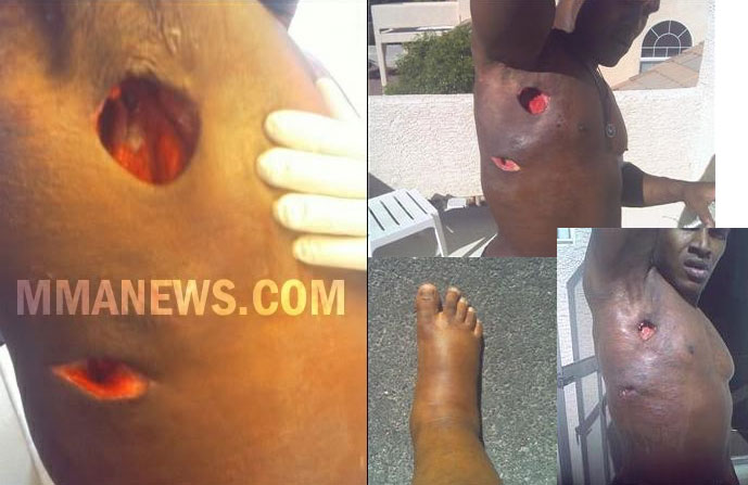 Kevin Randleman staph infectious disease causes | How do fighters get it